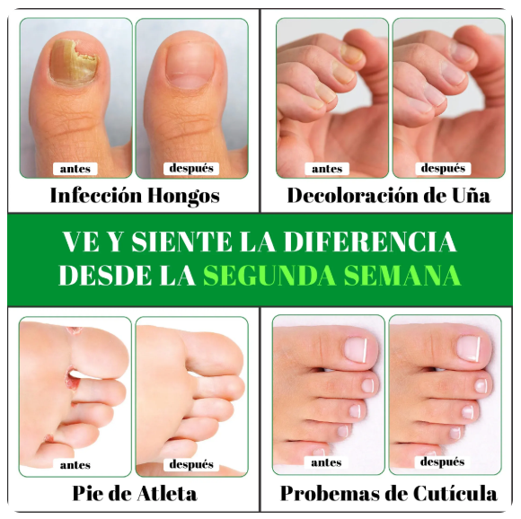 TERBINAFINA - GOTAS PARA HONGOS DE UÑAS