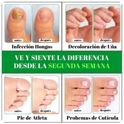 TERBINAFINA - GOTAS PARA HONGOS DE UÑAS